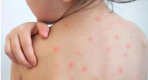 সিলেটে হামের উপসর্গ নিয়ে ১০ মাসের শিশুর মৃত্যু