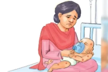 তিন মাসে হাম ও উপসর্গে মৃত্যু  ৬৫২