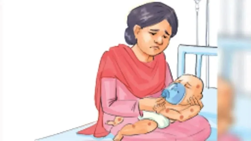 তিন মাসে হাম ও উপসর্গে মৃত্যু  ৬৫২