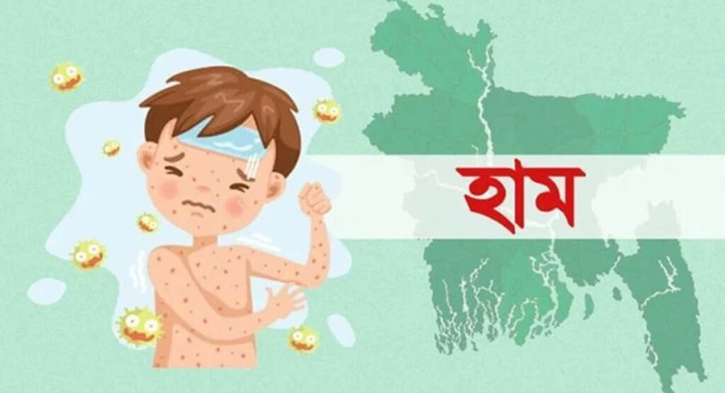সিলেট: হামের উপসর্গে আরও দুই শিশুর মৃত্যু