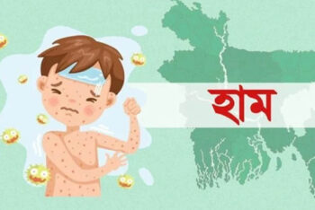 সিলেট: হামের উপসর্গে আরও দুই শিশুর মৃত্যু
