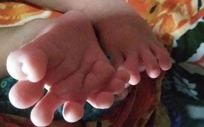 ২৮ আঙুল নিয়ে নবজাতকের জন্ম!