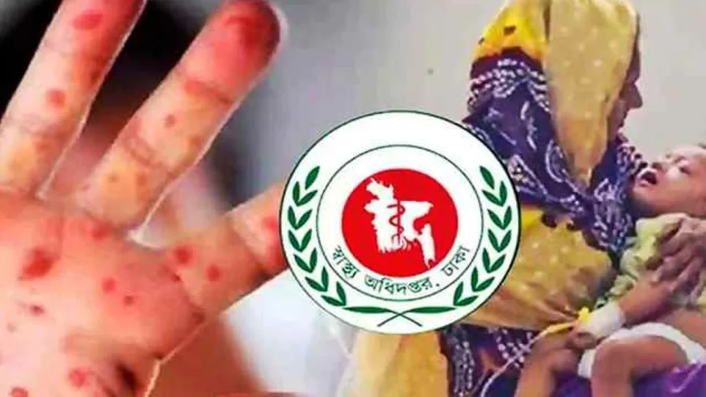 সিলেটে হামে আরো দুই শিশুর মৃত্যু, মৃতের সংখ্যা দাঁড়ালো ১৬৮ জনে
