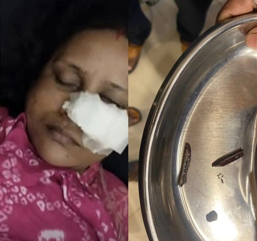 মৌলভীবাজার সদর হাসপাতালে সেলাইয়ের পর ক্ষতস্থানে পচন, অস্ত্রোপচারে বের হলো বাঁশের দুই টুকরো