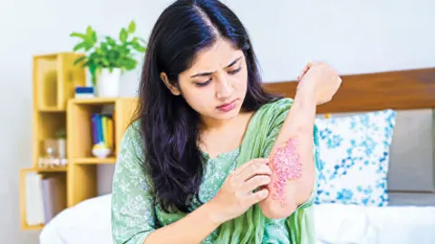 সোরিয়াসিসের লক্ষণ ও ঝুঁকি