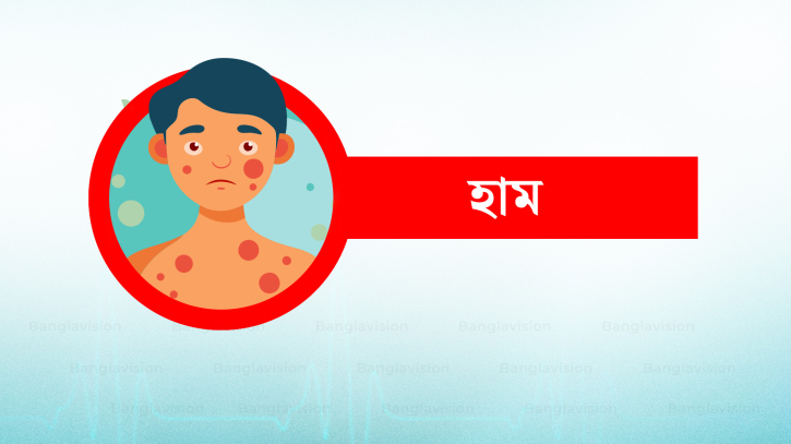 দেশে হাম উপসর্গ মৃত্যু ৬, আক্রান্ত ১৩৯৩